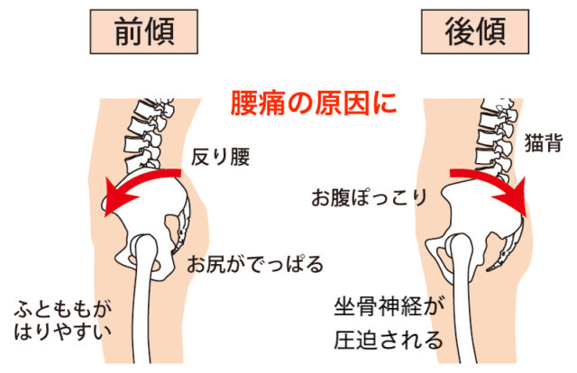 反り腰 女性にやさしい託児付きサロン Ccocoa接骨院 整体院