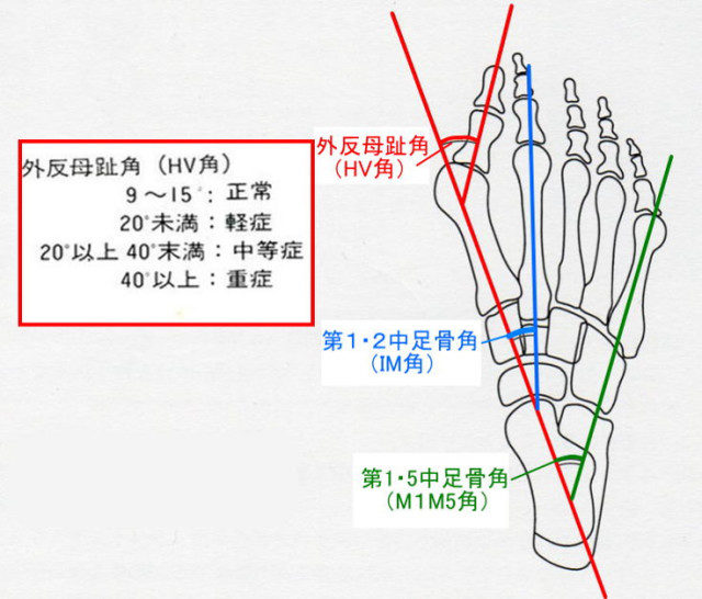 外反母趾角のイラスト